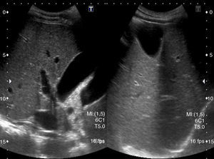 A non-dilated gallbladder with normal intrahepatic ducts.