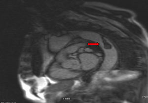 Angio-RM. Se observa trombo mural en aorta torácica descendente (flecha).
