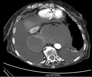 Vólvulo gástrico con necrosis de pared en corte transversal de TAC abdominal con contraste.