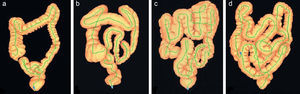Diferencias anatómicas del colon mediante reconstrucción 3D con tomografía computarizada que muestra diversos grados de complejidad. (Fuente: Khashab et al.11)