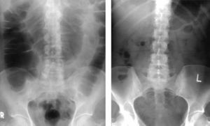 Radiografía de abdomen una hora después de la colonoscopia en un paciente en el que se utilizó aire (derecha) para la insuflación y en otro paciente que se utilizó CO2 (izquierda). (Fuente: Sumanac et al.19)