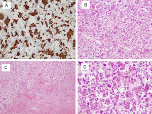 A) Inmunohistoquímica positiva para CD68 (×20): positividad en el componente gigantocelular. B) Hematoxilina-eosina (×10): lesión muy celular con patrón fascicular anárquico. C) Hematoxilina-eosina (×4): amplios focos de necrosis y hemorragia. D) Hematoxilina-eosina (×20): células fusiformes atípicas, células epitelioides y numerosas células gigantes de tipo osteoclásticas. Frecuentes figuras mitóticas.