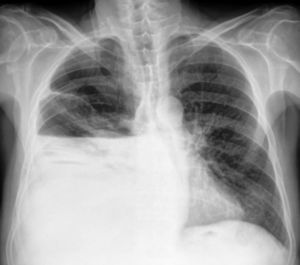 Chest X-ray with a right pleural effusion.