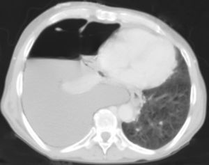 Thoracic CT scan revealing an enlarged right pleural effusion conditioning mediastinum deviation towards the opposite side.