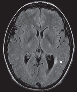 Cortes axial y sagital con RM en secuencia FLAIR. Lesión hiperintensa indicativa de áreas de desmielinización, a nivel periventricular adyacente a asta occipital izquierda (flecha).