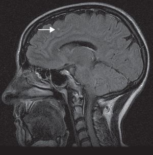 Lesión hiperintensa indicativa de áreas de desmielinización en sustancia blanca yuxtacortical en región frontal izquierda (flecha).