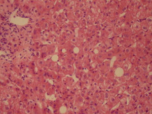 Espacio porta con muy escaso infiltrado inflamatorio linfocitario y macrovesículas de grasa aisladas en el lobulillo. (Hematoxilina-eosina, ×100.)