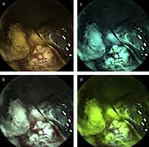 Neoplasia yeyunal visualizada con vista normal (a) y con FICE 1 (b), FICE 2 (c) y FICE 3 (d).
