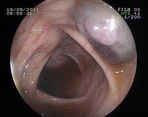 Lesión vascular de mayor tamaño en colon transverso.