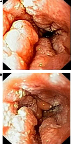 (A and B) Findings on first endoscopy: in between 26 and 34cm from dental arcade, mucosal folds are thickened and verrucous, protruding into the esophageal lúmen covered with white plaques.
