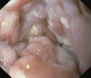 Findings on second endoscopy: re-stenosis at 30cm, with protruding pseudopolipoid thickened esophageal folds.