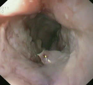 Findings on second endoscopy: distal stenosis ate 36cm, after balloon dilation.