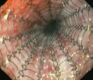 Findings on second endoscopy: fully covered metallic esophageal stent (Hannarostent, 120mm, 23/28mm) placement.