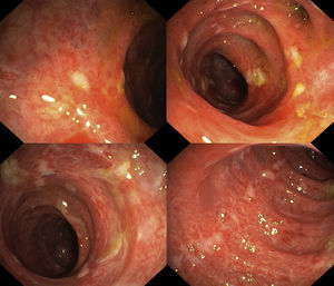 Úlceras irregulares parcheadas cubiertas de fibrina.