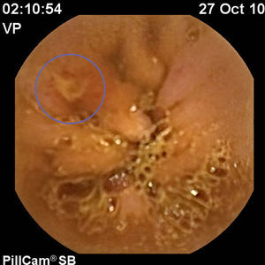 Úlcera ileal de gran tamaño en el ileon proximal.