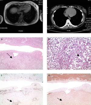Casos 1 y 2. Adenomas esteatósicos asociados a mutación HNF1α. Área tumoral señalizada con flecha negra.