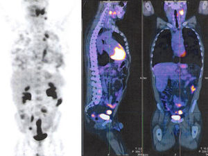 PET combinada con TC que muestra áreas hipermetabólicas en colon izquierdo, campos pulmonares y región laterocervical izquierda.