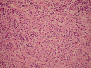 Ganglio linfático cervical. Infiltrado linfoide difuso constituido por células linfoides grandes (H-E, ×40).