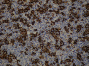 Ganglio linfático cervical. La coloración de inmunohistoquímica para CD20 resalta las células linfoides malignas grandes. Inmunohistoquímica CD20 ×40.