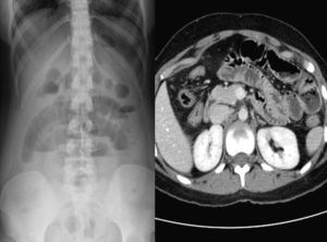 A) Radiografía simple de abdomen. B) TC abdominal.