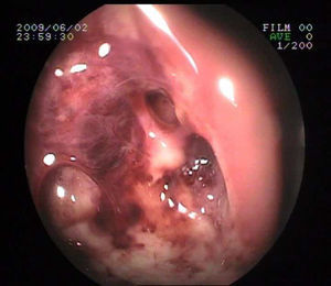 Colonoscopia que muestra a 10 cm del margen anal una ulceración profunda, que afecta a la tercera parte de la circunferencia, de fondo muy irregular y fibrinoso, con restos hemáticos adheridos y algún coágulo.