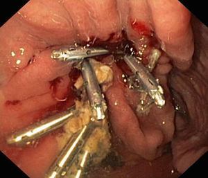 Tratamiento endoscópico de la fístula mediante inyección de Tissucol y colocación de clips endoscópicos en los 3 orificios internos de la fístula.