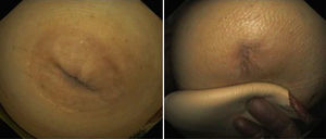 Imagen de la izquierda: aspecto inicial de la fístula previa a tratamiento. Imagen de la derecha: cierre de la fístula tras el tratamiento endoscópico.