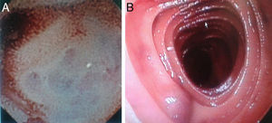 A y B) Imagen de cápsula endoscópica y enteroscopia posterior donde se identifican múltiples lesiones azuladas a lo largo del intestino delgado, a partir de yeyuno presentando sangrado activo.