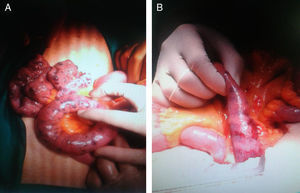 A y B) Imágenes de primera (A) y segunda (B) laparotomías exploradoras; donde se aprecia mejoría de las lesiones tras un mes de tratamiento con antiangiogénicos.