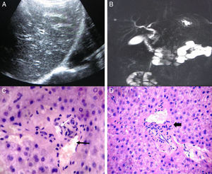 Ultrasonographic and CPMRI examinations. (A) Liver ultrasound: unchanged liver morphology. (B) CPMRI showing anormal bile ducts. (C, D) Histologic findings on liver biopsy specimen with Hematoxylin–eosin and PAS staining respectively demonstrate that branches of the hepatic artery (white arrow) and portal vein (black arrow) are present in the portal tract, but interlobular bile ducts are absent. There is a mild lymphocytic inflammatory infiltrate (thick arrow).