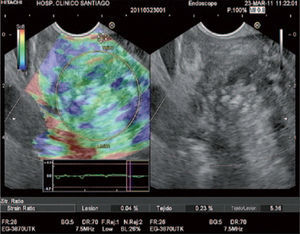 Coeficiente de elasticidad (strain ratio) de 5,36 de un paciente con masa inflamatoria en cabeza de páncreas en el contexto de una pancreatitis crónica.