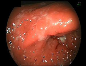 Imagen endoscópica que muestra una mucosa gástrica con edema y eritema, de aspecto nodular, friable al roce y con algunas regiones erosionadas y cubiertas de fibrina, que señala el diagnóstico de linfoma MALT gástrico.