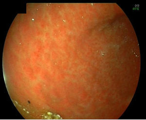 Imagen endoscópica de la mucosa gástrica exenta de lesiones, una vez iniciado el tratamiento con infliximab.