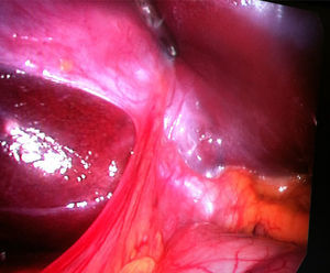 Small fibrous remnant was seen in the gallbladder fossa.