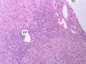 Denso infiltrado inflamatorio portal linfoplasmocitario con algunos eosinófilos. Intensa lesión necroinflamatoria de la interfase periportal con unión entre el espacio porta (EP) y la vena central (VC) por un puente de necrosis.