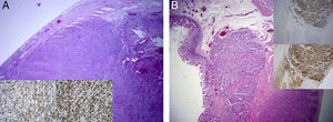 A) HE X20. Linfoma MALT. A la derecha de la imagen se identifica la mucosa intestinal y a la izquierda la subserosa. Las 2 fotografías pequeñas corresponden a inmunohistoquímica (IHQ X400) positiva para CD70 (izquierda) y Ki67>90% (derecha). B) HE X20. Tumor carcinoide. A la izquierda se aprecia la mucosa de íleon y a la derecha la muscular. Las 2 fotografías pequeñas corresponden a IHQ X20 para cromogranina positiva (arriba) y sinaptofisina (abajo).