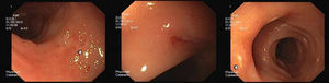 (see arrows) Ulcers in SBE (single-balloon enteroscopy).