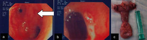 (a) Intraoperative enteroscopy – Meckel's diverticulum; (b) intraoperative enteroscopy – ulcerated Meckel's diverticulum with visible vessel; (c) Meckel's diverticulum – surgical specimen.