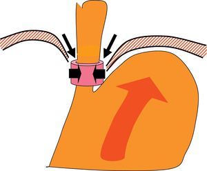 Mecanismos antirreflujo: el ángulo de Hiss, junto con la zona de alta presión generada por el esfínter esofágico inferior, y el refuerzo de los pilares del diafragma, interaccionan para redireccionar los ascensos del contenido gástrico hacia el fundo, e impedir el paso libre del contenido gástrico hacia el esófago.