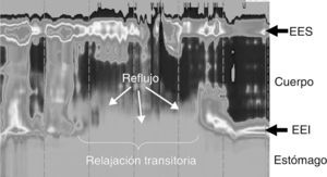 Reflujo gastroesofágico durante una relajación transitoria del esfínter esofágico inferior (EEI). El líquido gástrico (tonalidad gris clara) atraviesa la unión esofagogástrica coincidiendo con una relajación espontánea del EEI, que finaliza con una débil contracción del cuerpo esofágico que aclara del esófago el material refluido. EES: esfínter esofágico superior.