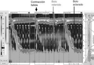 Manometría esofágica combinada con impedancia en un paciente con hipocontractilidad del cuerpo esofágico asociada a reflujo. Observar que entre 2 contracciones esofágicas normales se produce una onda fallida que se asocia a una retención del bolo de líquido ingerido (tonalidad gris clara) en el cuerpo del esófago. La siguiente onda peristáltica aclara todo el contenido líquido del esófago.