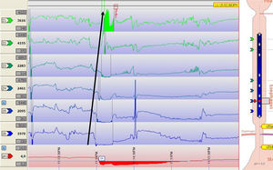 pH-impedanciometría ambulatoria. Se observa un episodio de reflujo como una caída de la impedancia en dirección retrógrada (ver flecha), que alcanza hasta zonas proximales del esófago. La medición simultánea de pH (canal inferior) permite determinar que se trata de un episodio de reflujo ácido.