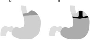 Efecto de acción del alginato sobre la cámara ácida posprandial. Tras la comida se genera una pequeña cámara con ácido (acid pocket) en la zona proximal del estómago (A). La ingesta de alginato crea una balsa o sobrenadante semisólido que flota por encima del líquido gástrico y desplaza la cámara ácida lejos de la unión esofagogástrica impidiendo el reflujo (B).