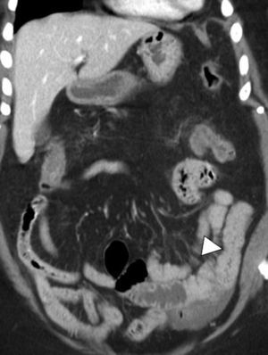 Tomografía computarizada (TC) abdominal que muestra engrosamiento concéntrico parietal de colon sigmoide y descendente, compatible con colitis segmentaria.