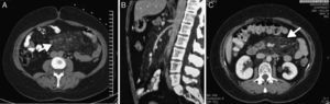 A) TC abdominal inicial, visión transversal con aumento de la densidad y el grosor del tejido adiposo mesentérico (flecha). B) TC abdominal inicial, visión sagital. C) TC abdominal de control 3 años después, donde no se observa clara disminución de la densidad ni el grosor de la grasa mesentérica (flecha).