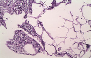 Biopsia con tinción de hematoxilina-eosina que muestra necrosis grasa y adipocitos con citoplasma espumoso.