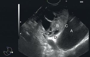 Aspecto endosonográfico de la lesión pericárdica en estudio: A) aurícula izquierda; B) lesión pericárdica; C) pared de la aurícula izquierda, y D) pericardio.