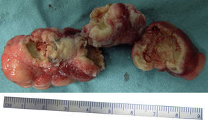 Tres de los 4 fragmentos de la tumoración extirpada que se pudieron recuperar. Obsérvese sus dimensiones con la regla de referencia.