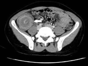Tomografía computarizada. La imagen más específica es la obtenida en un corte transversal a su eje que muestra la típica imagen en «diana» constituida por anillos concéntricos, que representan capas de mucosa, pared intestinal y grasa mesentérica.