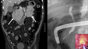 A: Abdominal CT showing pancreatic masses located in head and tail regions (arrows). B: ERCP: Long distal bile duct stricture with proximal biliary dilatation. Major duodenal papilla size increase in the cholangiography (arrows) and duodenoscopy (right lower corner).
